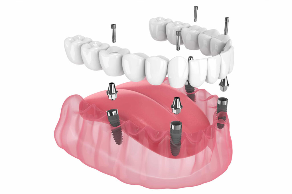 Konya All on 4 implant tedavisini gösteren sabit implant diş modeli