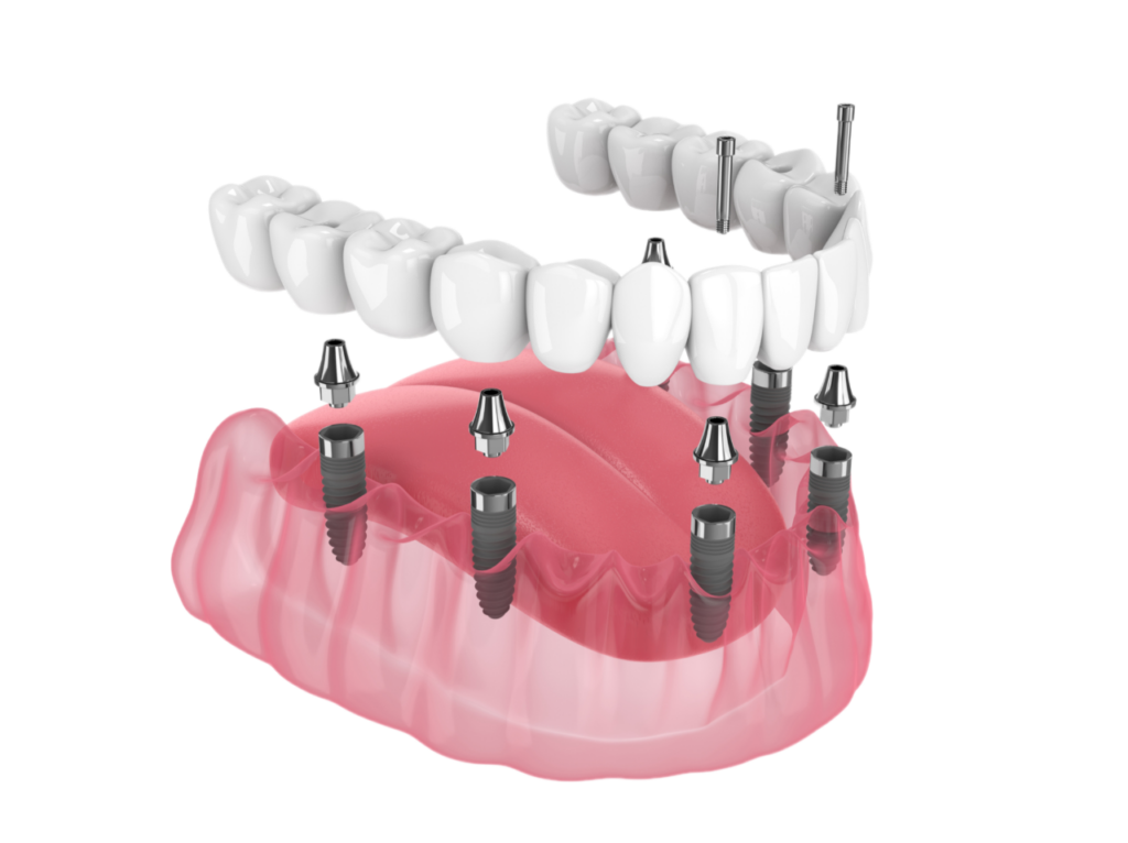 All on 6 implant sisteminde 6 implant üzerine sabit dişlerin yerleştirilmesi