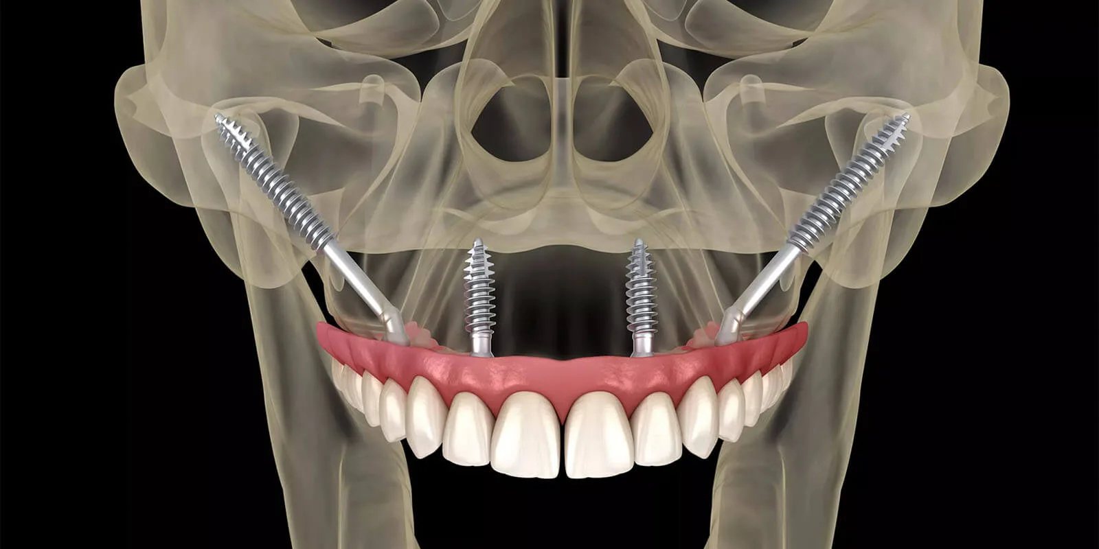 Zigomatik implant nasıl yapılır üst çenede elmacık kemiğine yerleştirilen implant sistemi görseli