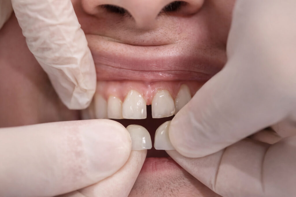 Diastema kapatma için bonding ve estetik gülüş planlaması yapılan klinik uygulama