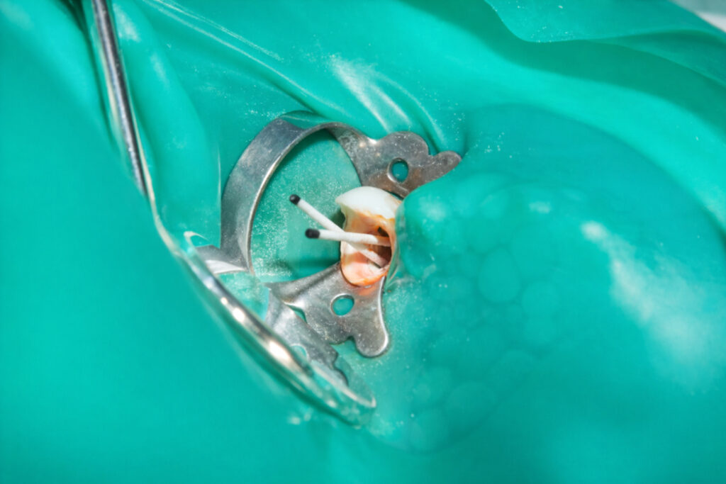 Konya açık apeks endodontik tedavi sürecinde kök ucunun değerlendirilmesi