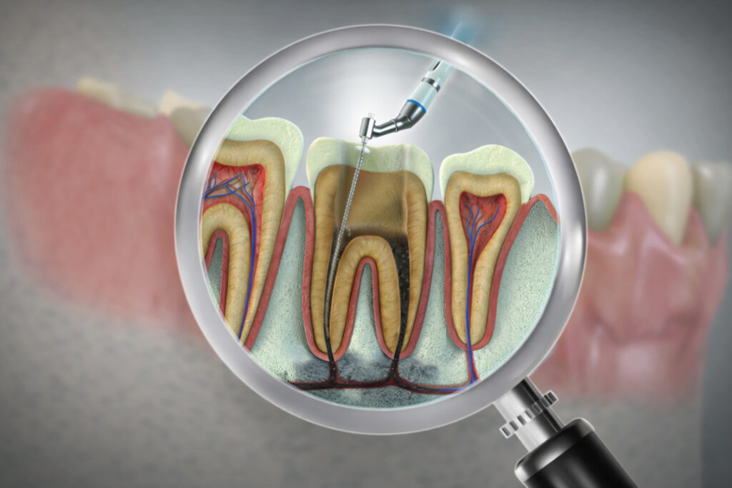 Konya endodontik tedavi sırasında diş kökü yapısının değerlendirilmesi